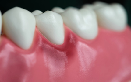Diş İmplantı Tedavisi Temel Bilgiler